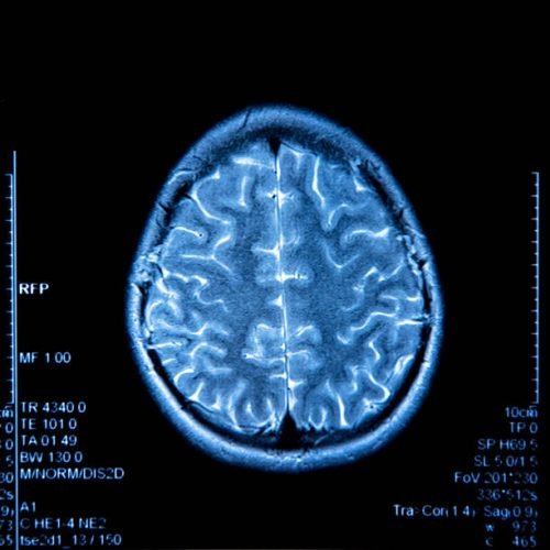 MRI image of brain NDIS Nursing Services Australia